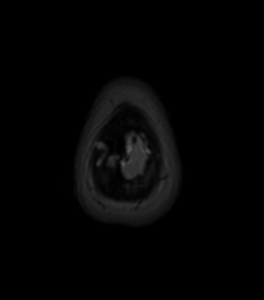 Choroid plexus carcinoma (Radiopaedia 91013-108553 Axial T2 fat sat 156).jpg