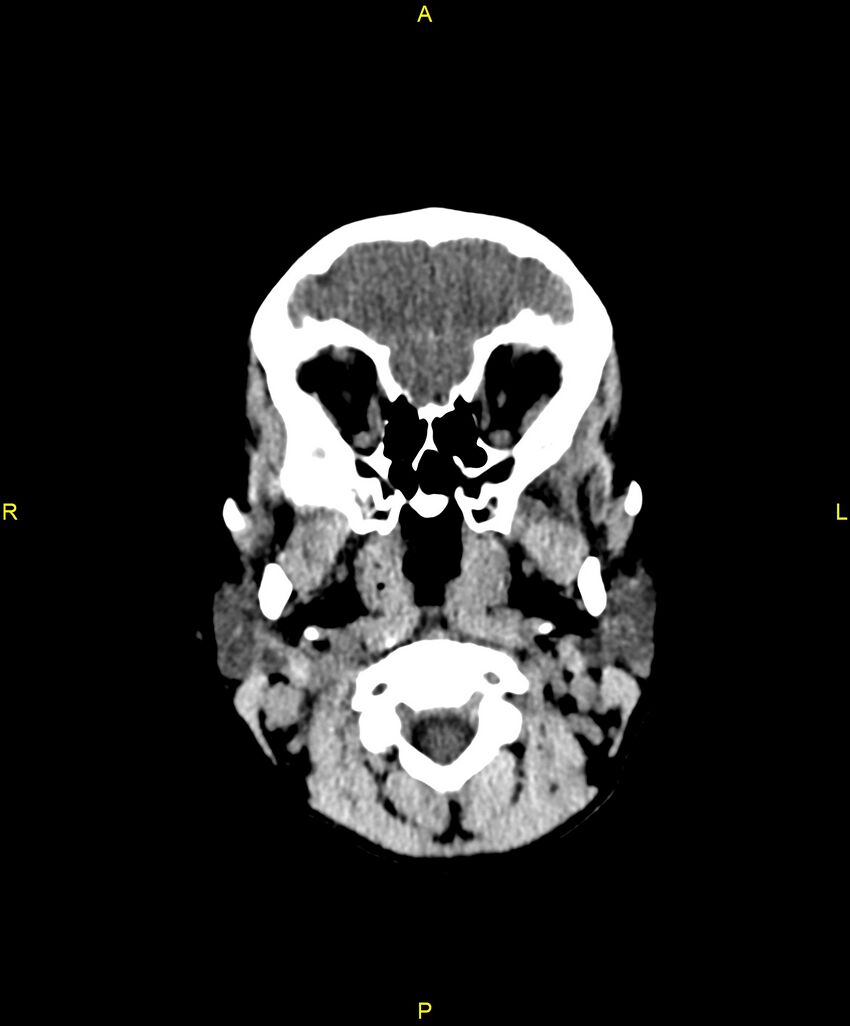 Choroidal fissure cyst (Radiopaedia 89481-106465 Axial non-contrast 16).jpg