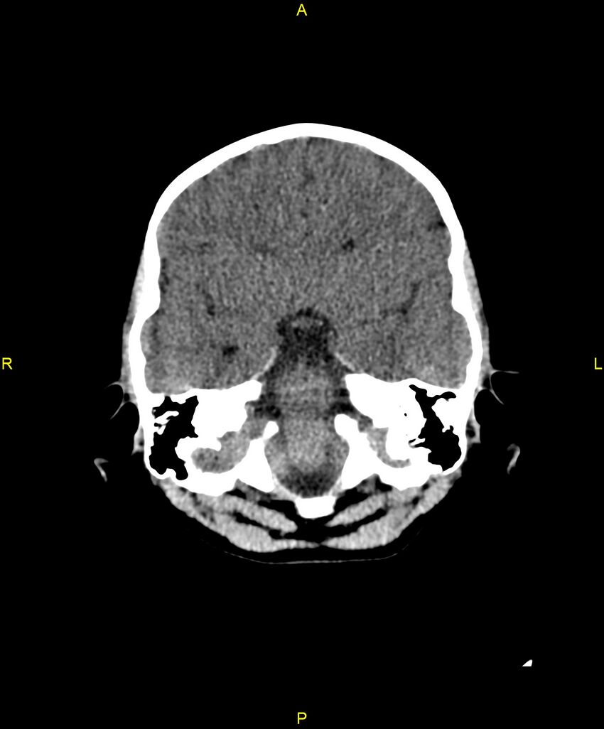 Choroidal fissure cyst (Radiopaedia 89481-106465 Axial non-contrast 41).jpg
