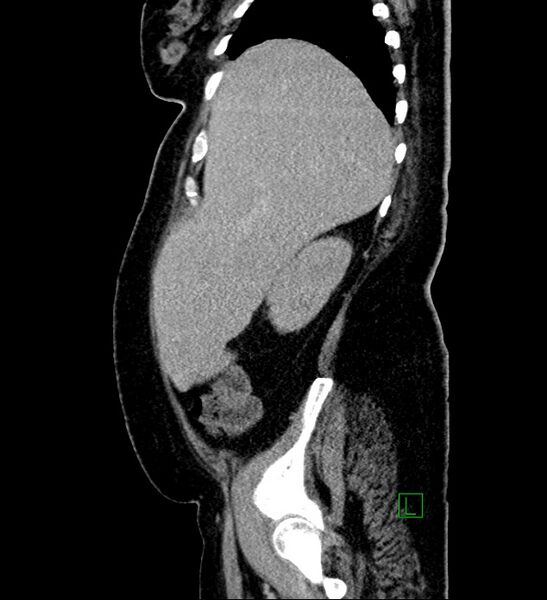 File:Chromophobe renal cell carcinoma (Radiopaedia 84239-99519 G 93).jpg
