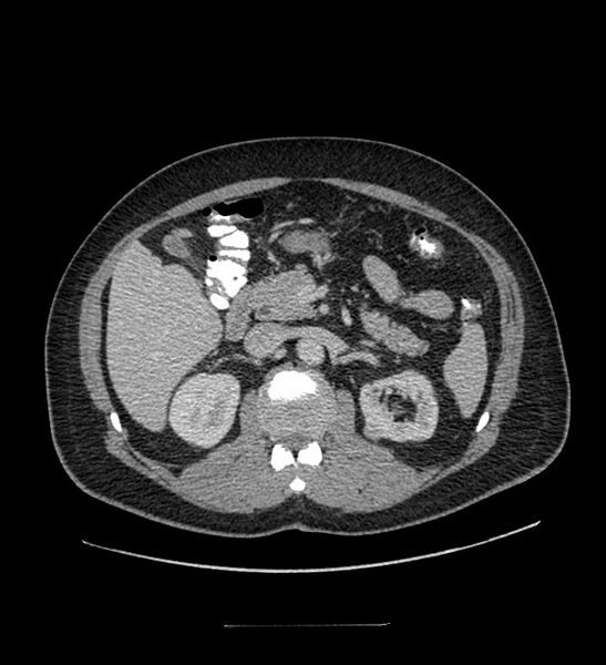 File:Chromophobe renal cell carcinoma (Radiopaedia 84337-99644 C 49).jpg