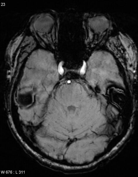 File:Chronic lymphocytic inflammation with pontine perivascular enhancement responsive to steroids (CLIPPERS) (Radiopaedia 37520-39374 Axial SWI 22).jpg
