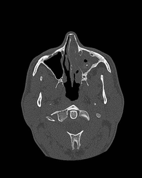 File:Chronic maxillary sinusitis caused by a foreign body (Radiopaedia 58521-65676 Axial bone window 126).jpg