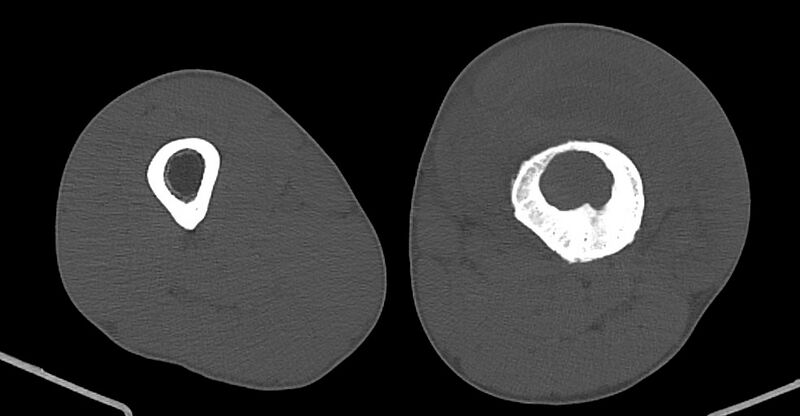 File:Chronic osteomyelitis (with sequestrum) (Radiopaedia 74813-85822 Axial non-contrast 114).jpg