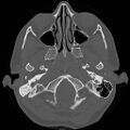 Chronic otomastoiditis (Radiopaedia 27138-27309 Axial bone window 6).jpg