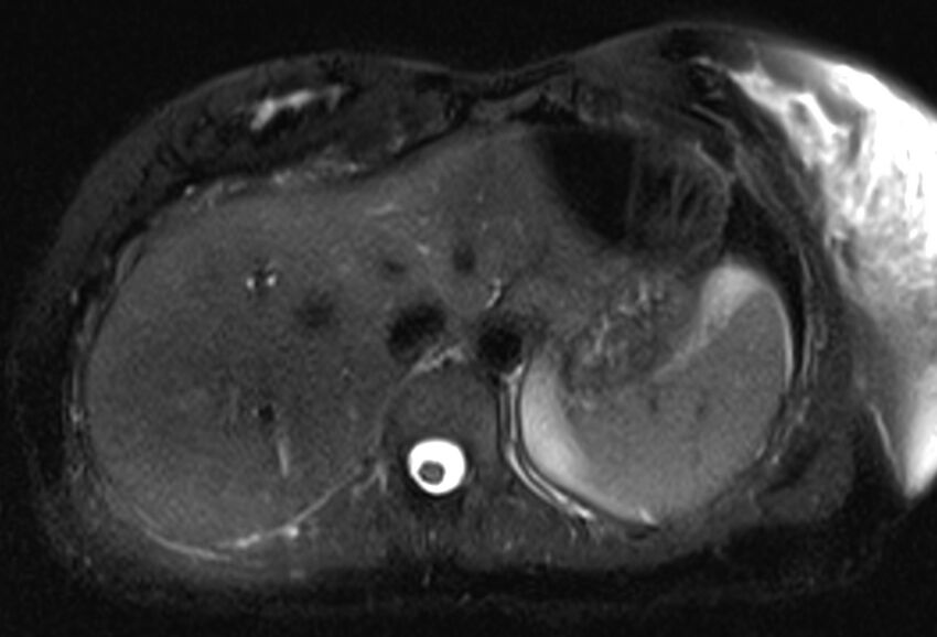 Chronic pancreatitis - pancreatic duct calculi (Radiopaedia 71818-82250 Axial T2 fat sat 10).jpg