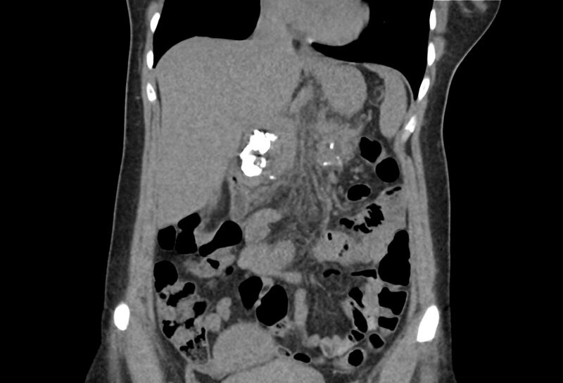 File:Chronic pancreatitis - pancreatic duct calculi (Radiopaedia 71818-82251 Coronal non-contrast 16).jpg