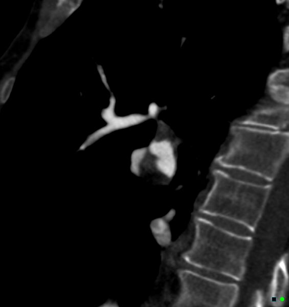 File:Chronic pulmonary embolism (Radiopaedia 17943-17702 Sagittal C+ CTPA 61).jpg