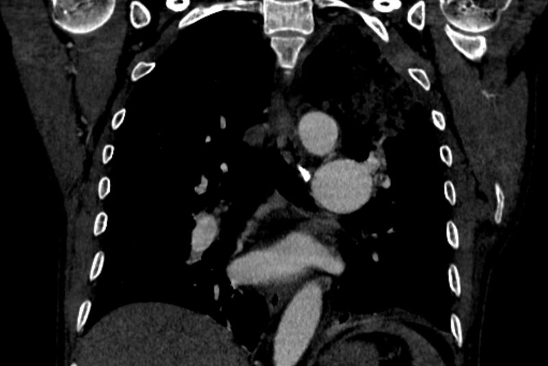 File:Chronic pulmonary embolism with bubbly consolidation (Radiopaedia 91248-108850 B 86).jpg