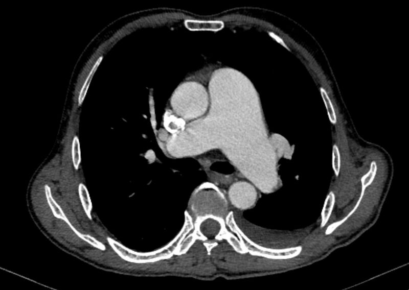 File:Chronic pulmonary embolism with bubbly consolidation (Radiopaedia 91248-108850 C+ arterial phase 66).jpg