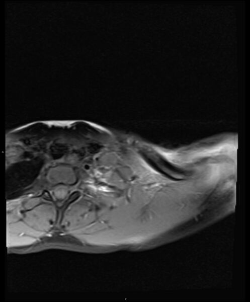 File:Chronic reactive multifocal osteomyelitis (CRMO) - clavicle (Radiopaedia 56406-63114 Axial T1 fat sat 8).jpg