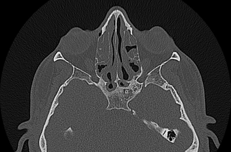 File:Chronic rhinosinusitis (Radiopaedia 65079-74075 Axial bone window 48).jpg