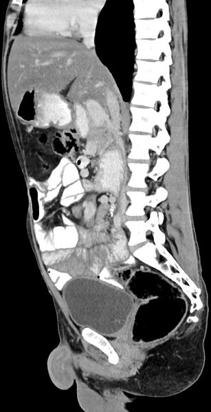 File:Chronic small bowel volvulus (Radiopaedia 75224-86322 C 81).jpg