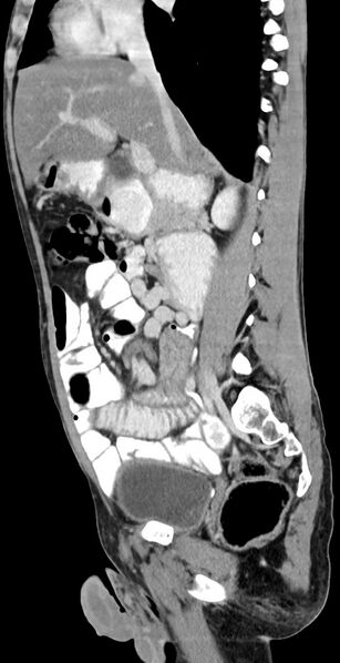 File:Chronic small bowel volvulus (Radiopaedia 75224-86322 C 88).jpg