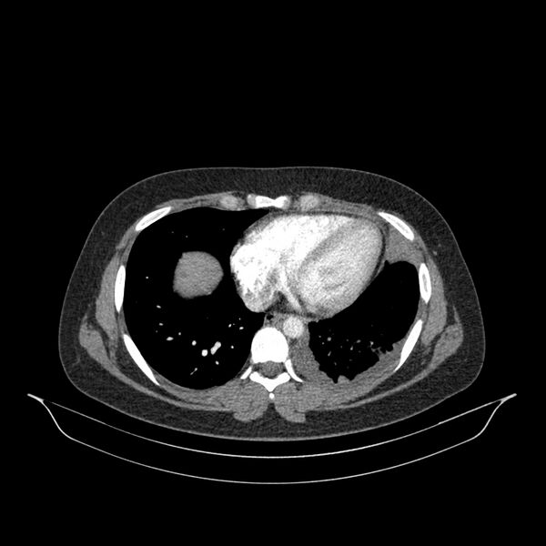 File:Chronic thromboembolic pulmonary hypertension (CTEPH) (Radiopaedia 74597-85532 Axial C+ CTPA 55).jpg