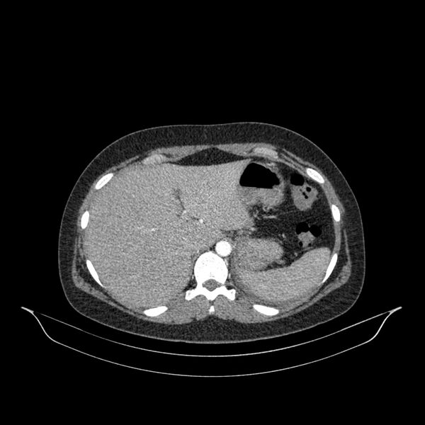File:Chronic thromboembolic pulmonary hypertension (CTEPH) (Radiopaedia 74597-85532 Axial C+ CTPA 8).jpg