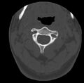 Clay-shoveler fracture (Radiopaedia 22568-22590 Axial bone window 18).jpg