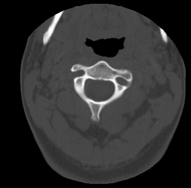 File:Clay-shoveler fracture (Radiopaedia 22568-22590 Axial bone window 18).jpg