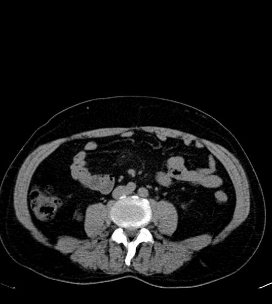 File:Clear cell renal cell carcinoma (Radiopaedia 85006-100539 Axial non-contrast 51).jpg