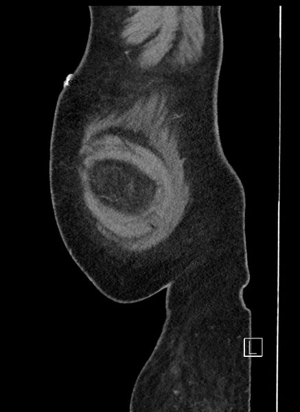 File:Closed loop obstruction - internal hernia into nephrectomy bed (Radiopaedia 59867-67320 C 109).jpg