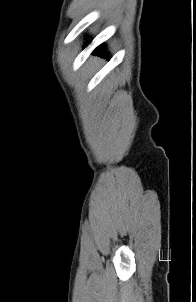 File:Closed loop small bowel obstruction - internal hernia (Radiopaedia 57806-64778 C 10).jpg