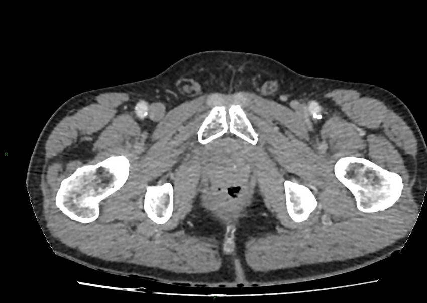 Closed loop small bowel obstruction with ischemia (Radiopaedia 84180-99456 A 123).jpg