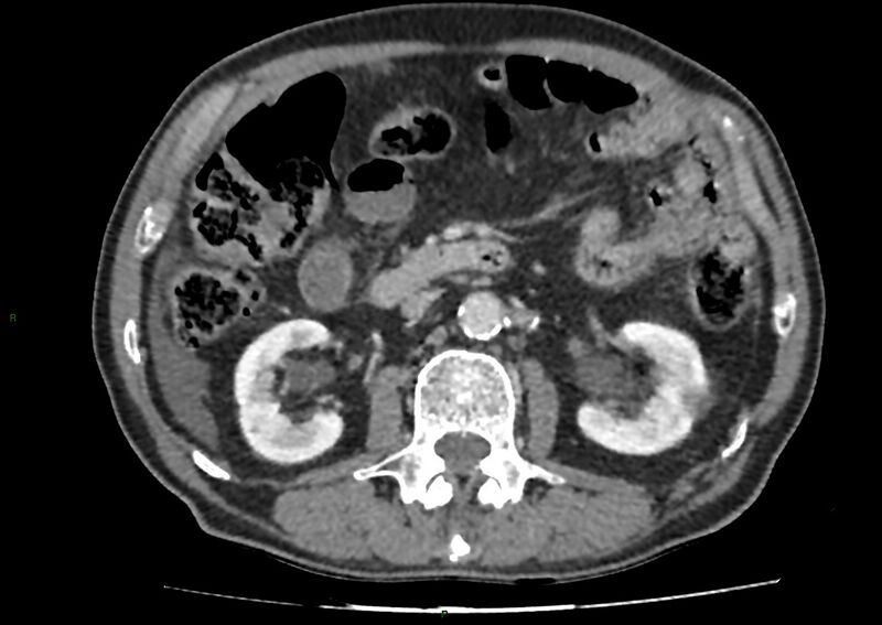 File:Closed loop small bowel obstruction with ischemia (Radiopaedia 84180-99456 A 50).jpg