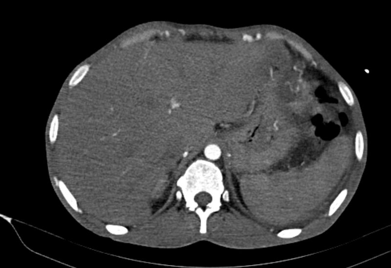 File:Coarctation of aorta with aortic valve stenosis (Radiopaedia 70463-80574 A 222).jpg
