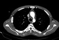 Coarctation of aorta with aortic valve stenosis (Radiopaedia 70463-80574 A 47).jpg