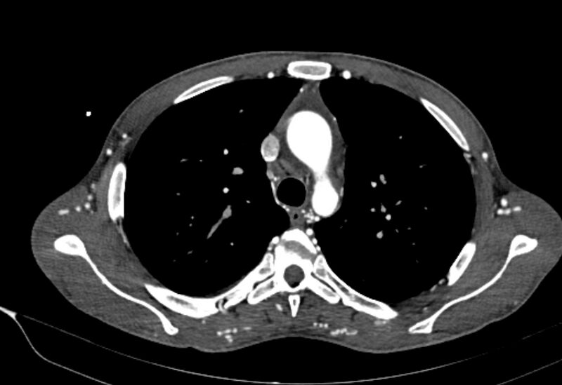 File:Coarctation of aorta with aortic valve stenosis (Radiopaedia 70463-80574 A 47).jpg