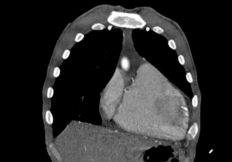 File:Coarctation of aorta with aortic valve stenosis (Radiopaedia 70463-80574 C 33).jpg