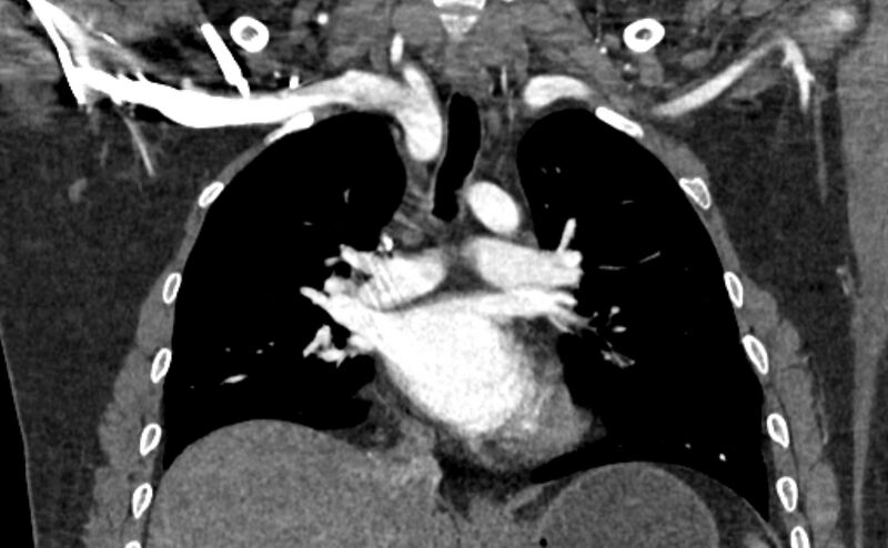 File:Coarctation of the aorta (Radiopaedia 53363-59343 C 35).jpg