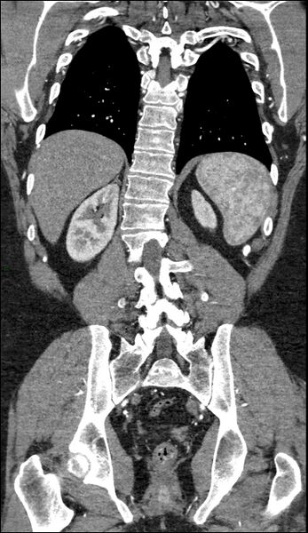 File:Coarctation of the aorta (Radiopaedia 74632-88521 B 187).jpg