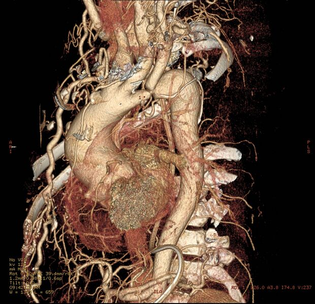 File:Coarctation of the aorta (Radiopaedia 8681-9490 C 1).jpg