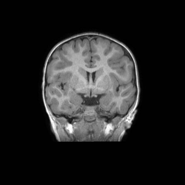 File:Cochlear nerve aplasia - unilateral (Radiopaedia 87910-104413 Coronal T1 24).jpg