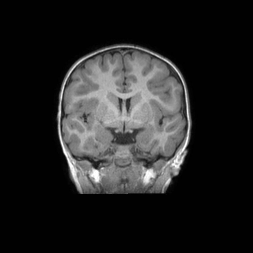Cochlear nerve aplasia - unilateral (Radiopaedia 87910-104413 Coronal T1 24).jpg