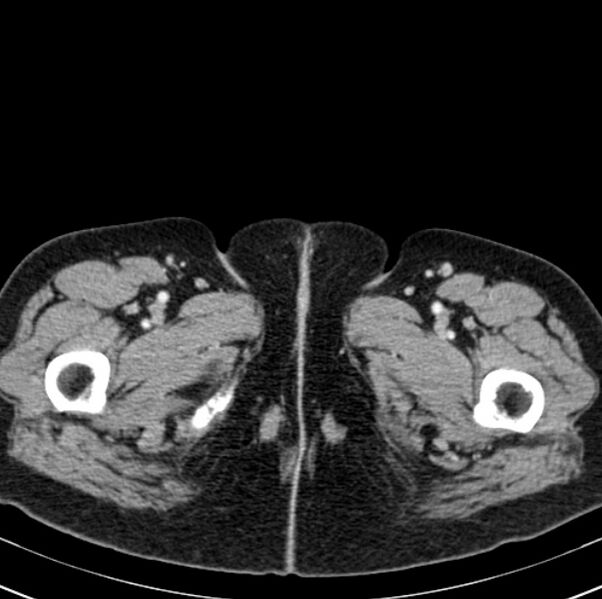 File:Colon carcinoma with hepatic metastases (Radiopaedia 29477-29961 A 131).jpg