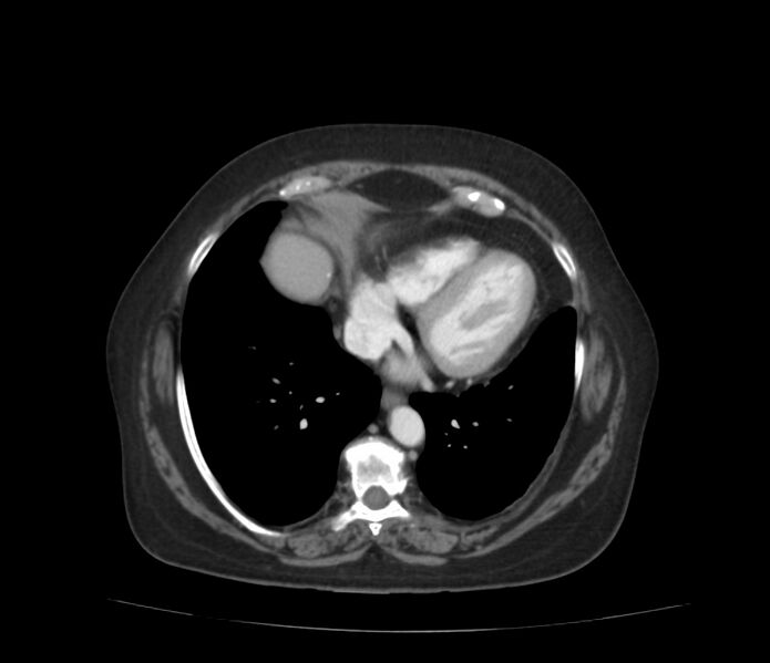 File:Colonic diverticulosis (Radiopaedia 22934-22957 A 3).jpg