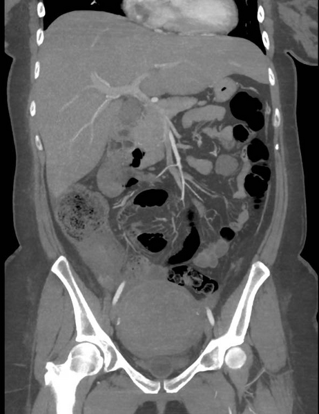 File:Colonic pseudo-obstruction (Radiopaedia 79752-92980 B 31).png