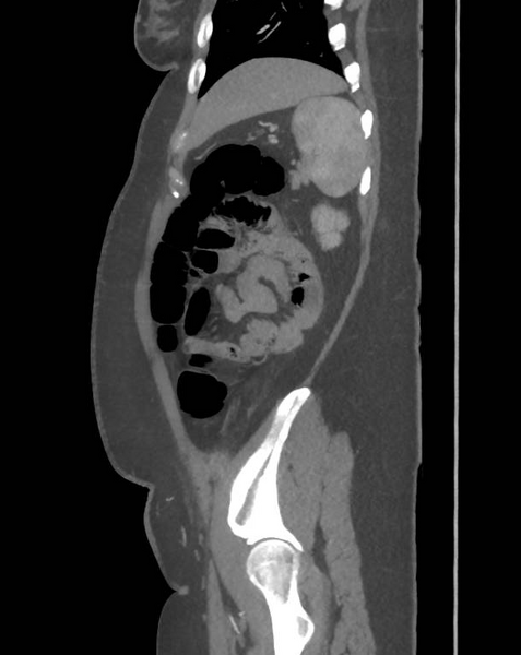File:Colonic pseudo-obstruction (Radiopaedia 79752-92980 C 61).png