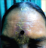 Contact dermatitis (bindi).png
