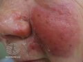 Erysipelas recurs in up to one-third of patients due to- (DermNet NZ bacterial-erysipelas4).jpg