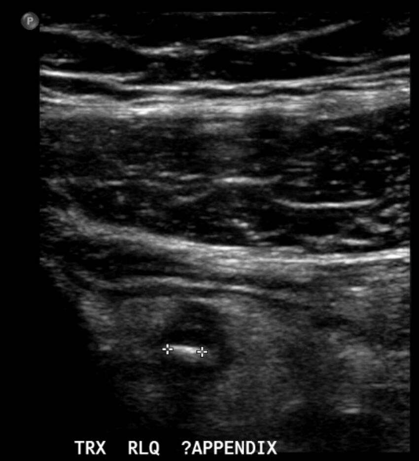 Figure 10.9A Child ultrasound of appendix, short axis, demonstrating a thick-walled appendix with an appendicolith.jpg