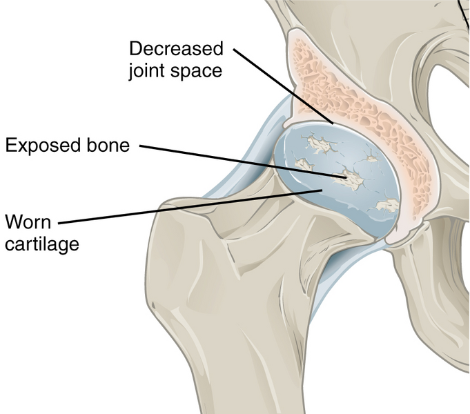 File:Hip osteoarthritis (illustration) (Radiopaedia 47973-52754 None 2).png