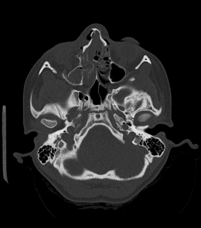 Nasoorbitoethmoid fracture (Radiopaedia 90044-107205 Axial bone window 73).jpg