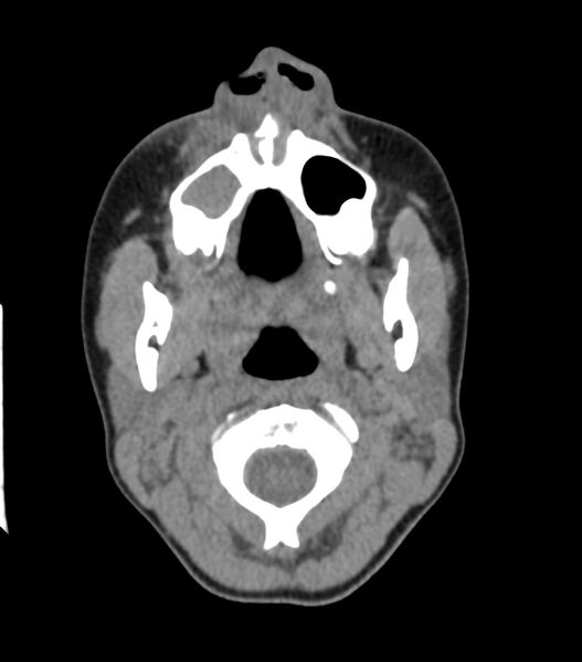 File:Nasoorbitoethmoid fracture (Radiopaedia 90044-107205 Axial non-contrast 99).jpg