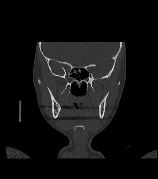 File:Nasoorbitoethmoid fracture (Radiopaedia 90044-107205 Coronal bone window 68).jpg