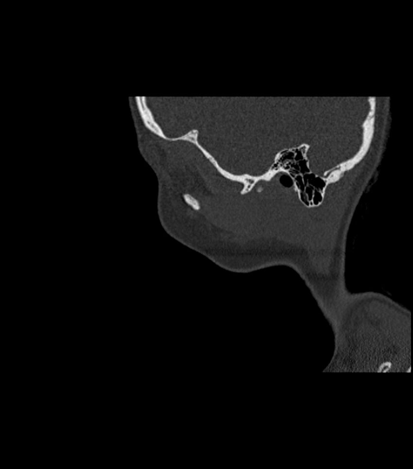Nasoorbitoethmoid fracture (Radiopaedia 90044-107205 Sagittal bone window 24).jpg