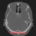 Nasopharyngeal carcinoma recurrence - skull base destruction (Radiopaedia 29107-29490 Axial bone window 74).jpg