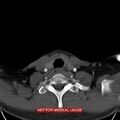 Nasopharyngeal carcinoma recurrence - skull base destruction (Radiopaedia 29107-29491 A 31).jpg